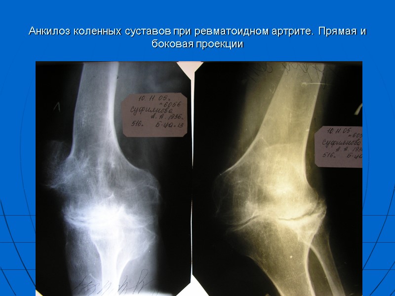 Анкилоз коленных суставов при ревматоидном артрите. Прямая и боковая проекции